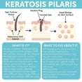 thumbnail image 3 of Body Soap for Keratosis Pilaris | Exfoliating Soap Scrub with 10% AHA & Micro Pumice Beads | Buffingbar for Smooth Skin, Strawberry Legs, Ingrown Hair & Razor Bumps, 3 of 7