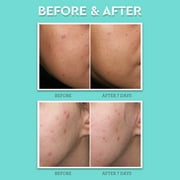 Bliss Clear Genius Acne Spot Treatment