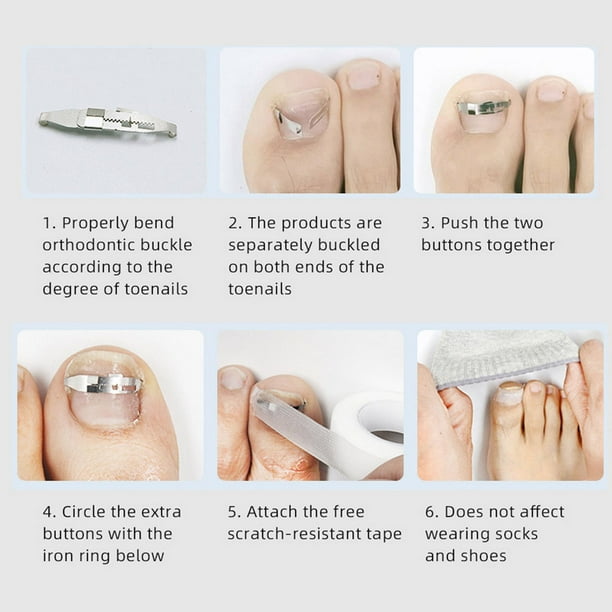 6 Best Products for Removing Ingrown Toenails