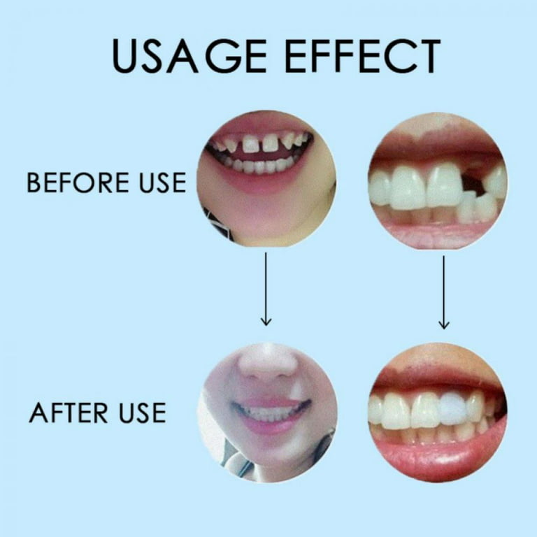 Yinrunx Tooth Repair Kit Gaps Filling Tool Teeth Temp Tooth Fake Teeth  Denture Glue for Dental Cement Temporary Tooth Fangs with Glue Teeth Gaps  False Teeth Solid Glue Denture Adhesive Repair Kit 