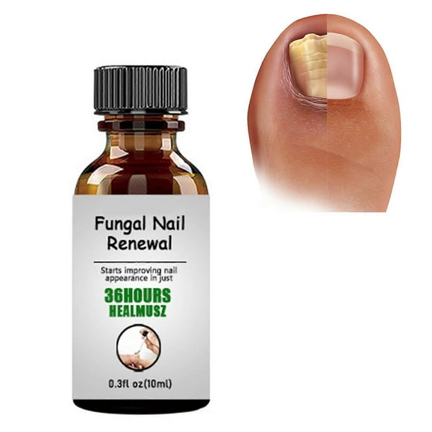 Nail Ingrown Repair Solution Anti-Infection Onychomycosis Paronychia Repair Serum for Broken Cracked Split and Weak Nails