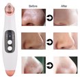 thumbnail image 1 of Remove Pimples Instrument, Six Suction Heads USB Interface Electric Pore Cleanser Fast Charging  for Skin, 1 of 7