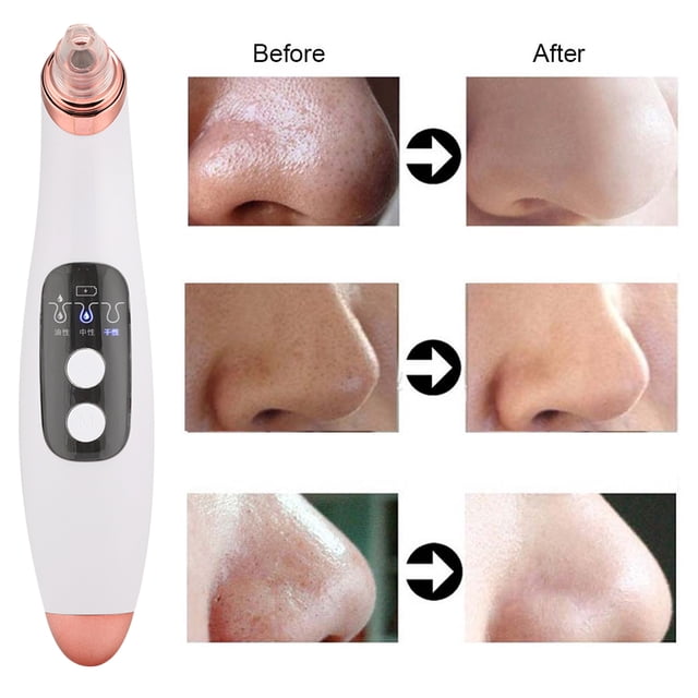 Remove Pimples Instrument, Six Suction Heads USB Interface Electric Pore Cleanser Fast Charging for Skin