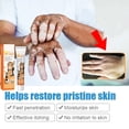 thumbnail image 5 of Ungüento para eliminar eficazmente el Vitiligo, pomada para eliminar manchas blancas, cuidado de la piel, 5 of 5