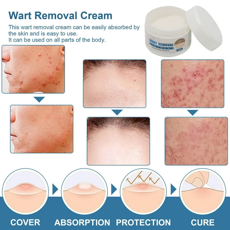 Eelhoe Wart Remover Ointment Side Effects Isoftbytes eelhoe-wart-remover-ointment-side-effects-isoftbytes
