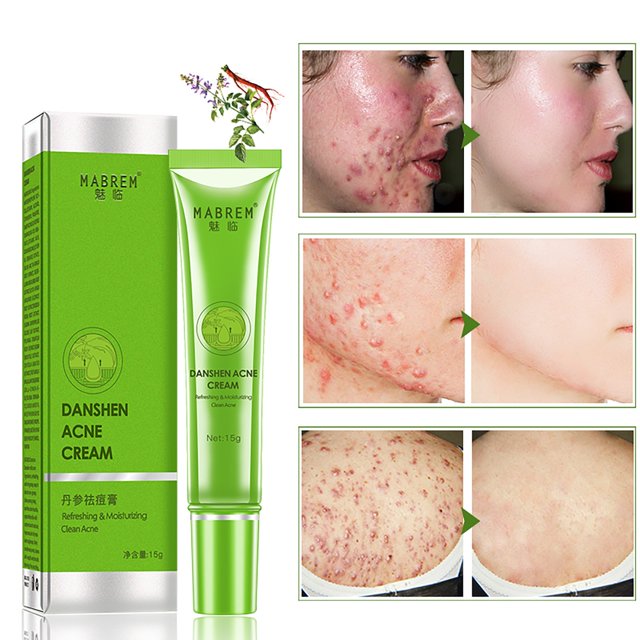 Clearance, Acne Remove Acne Oil Control Oil Shrink Pores Whitening and Moisturizi