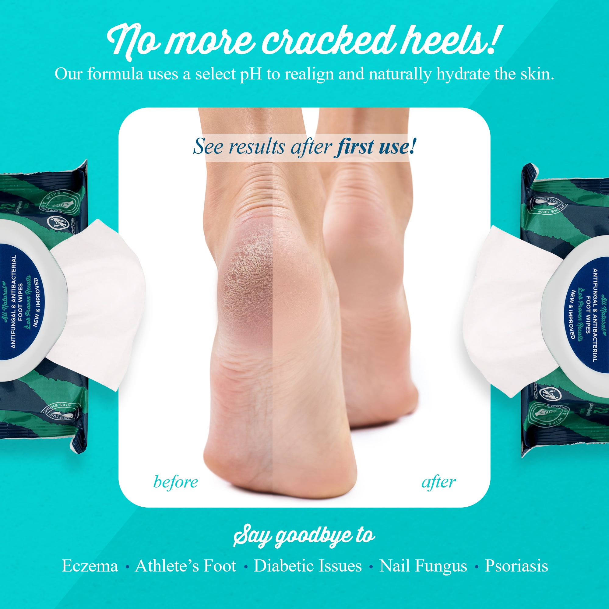 pHeet® Foot Wipes - Stops Burning & Itching, All-Natural, Cleanses, Moisturizes, Improves Dry, Cracked & Flaky Skin 72ct