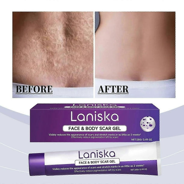 Advanced Scar Gel for Face & Body, Scar Treatment for Surgical Scars, Stretch Marks, Scars of Burns and Injuries, Acne Scar Treatment