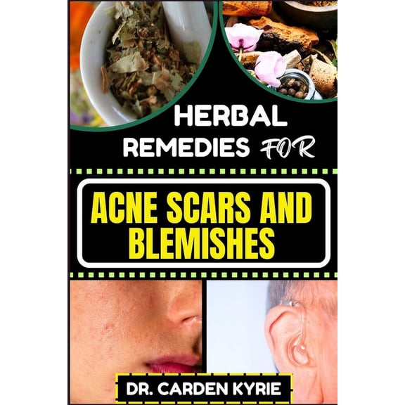Herbal Remedies for Acne Scars and Blemishes: Key Insights for a Flawless Complexion, focusing on Natural Healing, Lasti, (Paperback)