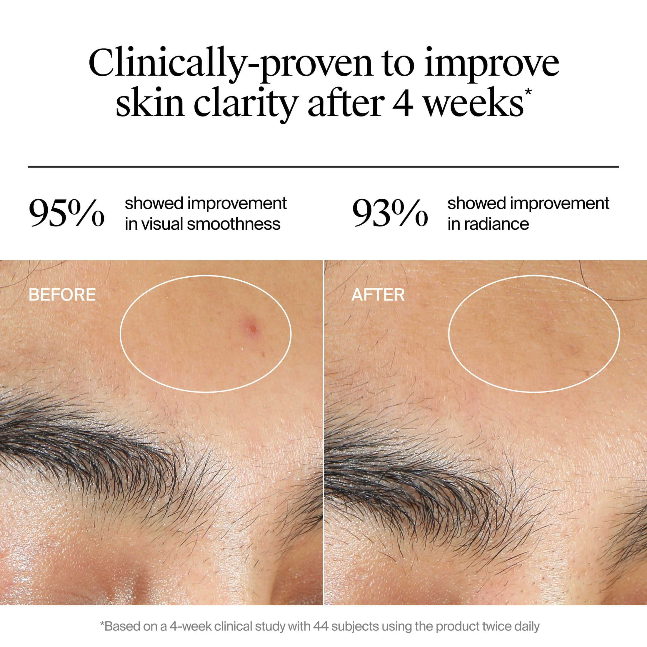 Neutrogena Evenly Clear Acne Gel Moisturizer, 1.7 fl. oz