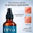 thumbnail image 4 of Agatha Spray dermolimpiador para piel expuesta, comprometida y con lesiones recurrentes, 4 of 5