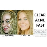 Sulfur 6.6% Anti Acne Drying Lotion - Joesoef Skin Care 100ml