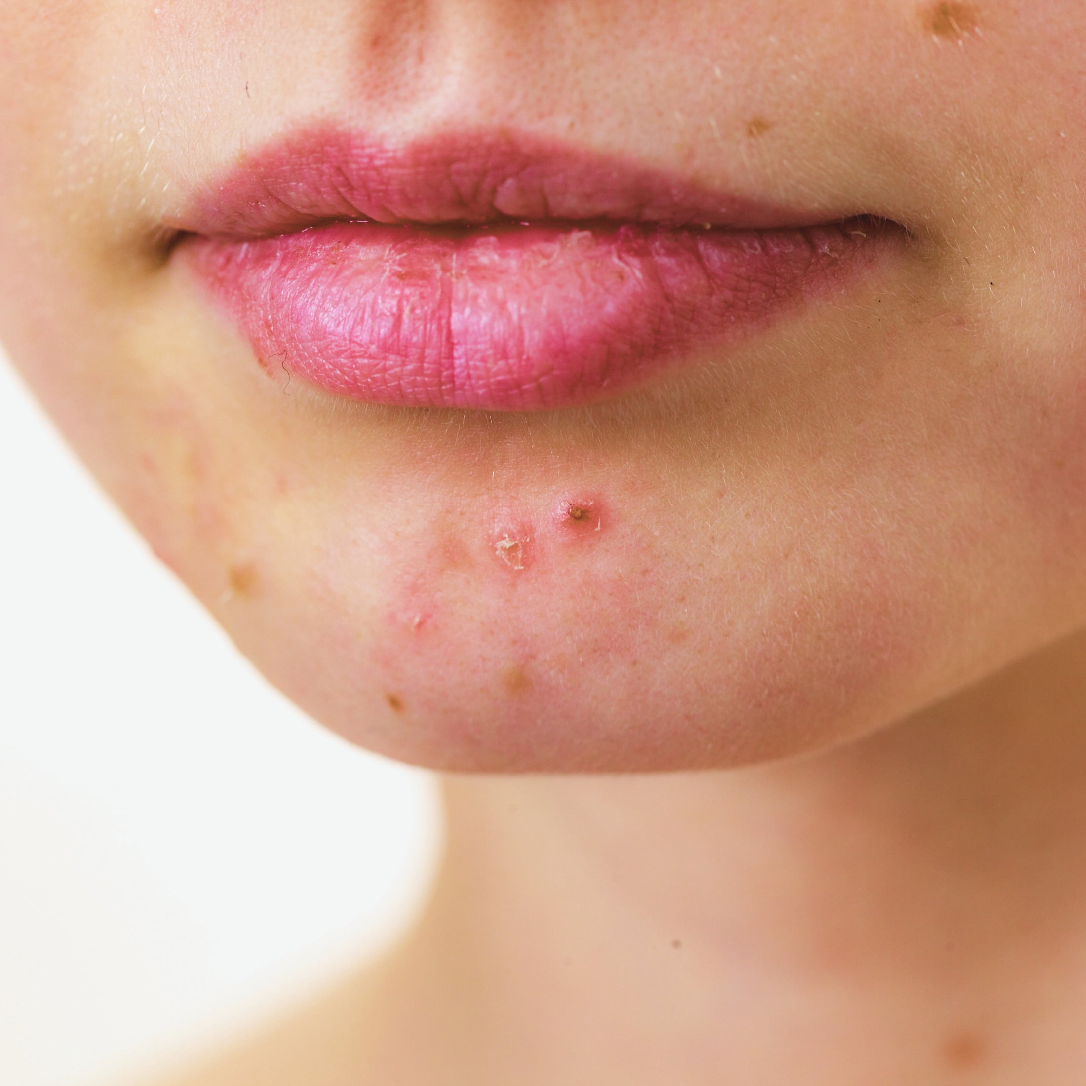 Mettalusso MORIIS Modern Acne and Post Shave Skincare Treatment