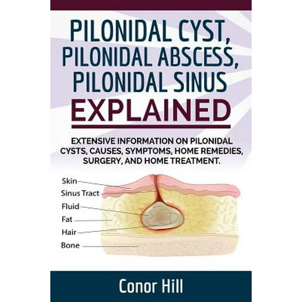 Pilonidal Cyst Fast Healing Guide. Fast Track Guide to Pilonidal Cyst