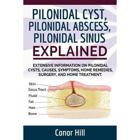Pilonidal Cyst Fast Healing Guide. Fast Track Guide to Pilonidal Cyst Relief by Understanding the Pilonidal Sinus, Abscess, Causes, Symptoms, and Applying Home Remedies and (Best Home Remedy For Cyst)