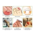 thumbnail image 4 of Ingrown Toenail Corrector Stickers, 10pcs Ingrown Toenail Corrector Patch  For Home For Woman, 4 of 8