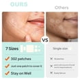 thumbnail image 4 of Hydrocolloid Acne Patch – 7 Sizes, 302 Patches Waterproof Protective Cover for Day & Night Use on Blemishes & Spots, 4 of 6