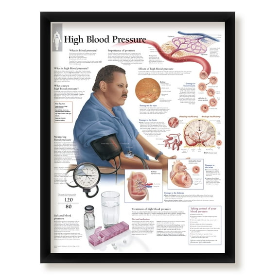 High Blood Pressure Framed Medical Educational Informational Poster Diagram Doctors Office School Classroom 22x28 Inches