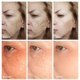 thumbnail image 2 of Nicotinamida-crema blanqueadora para eliminar manchas oscuras, Melasma, pigmentación, antienvejecimiento, ilumina la piel facial"22PCS" Fivean LED, 2 of 2