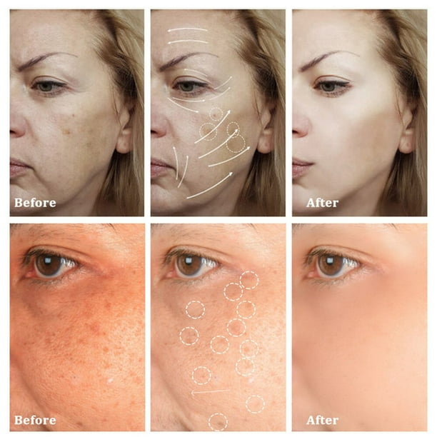 Super Skin Lightener Cream - 5oz For Dark Spots, Acne Scars & Hyperpigmentation