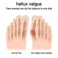 thumbnail image 4 of Podiatry Bunion Relief Sleeve, 4 of 5