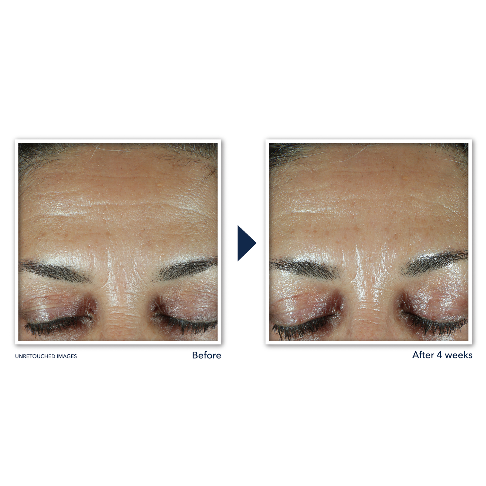 RoC Retinol Correxion Deep Wrinkle Filler photo 4