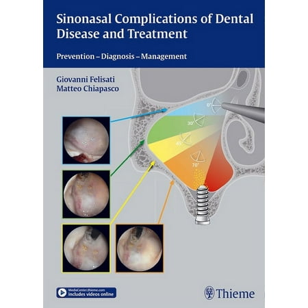 UPC: 9783131997012 | Sinonasal Complications of Dental Disease and Treatment: Prevention – Diagnosis – Management (Hardcover)