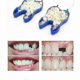 thumbnail image 3 of temporary dentures, 3 of 4