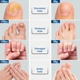 thumbnail image 4 of Tratamiento para hongos en las uñas de los pies OSIMOON Extra Strength 10% Acid, 4 of 7
