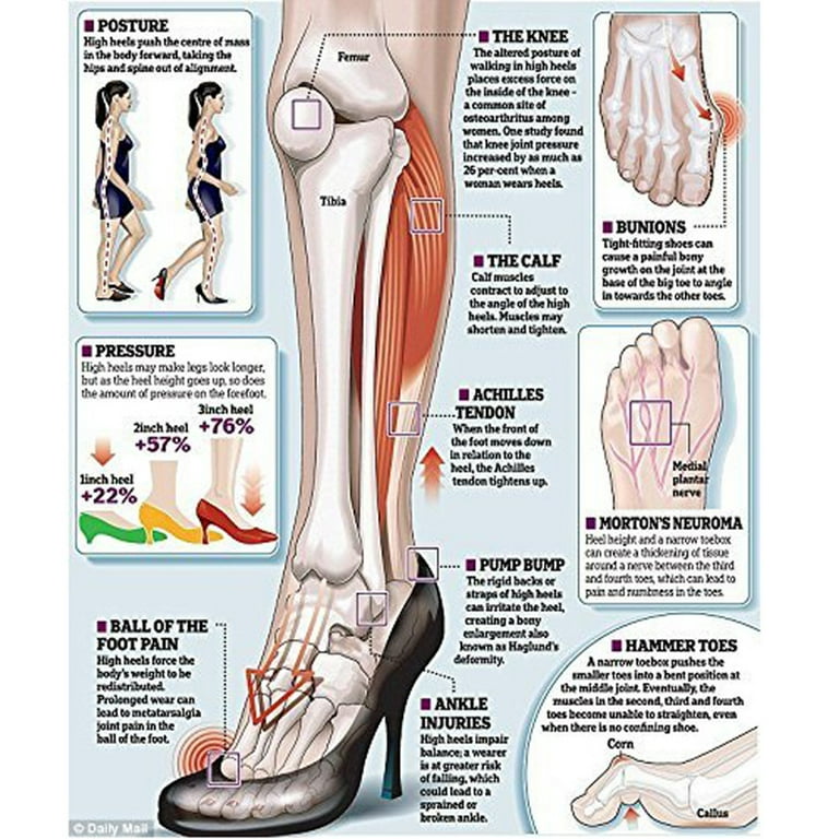 Sprained Ankle Heel And Middle Foot Pain Ankle Sprains Treatment