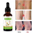 thumbnail image 4 of Aceite esencial para masaje de venas varicosas en las piernas, cuidado hidratante, solución calmante para el cuidado de las piernas para mejorar la circulación sanguínea, 4 of 7