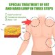 thumbnail image 3 of ZHAOCHENG 2 uds., 20 g, crema para eliminar lipomas, lipólisis, apósito para aliviar bultos de grasa, crema para eliminar grasa e hinchazón de la piel, cuidado de la salud, 3 of 5