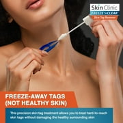 Skin Clinic FREEZE n CLEAR Skin Tag Remover