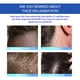 thumbnail image 3 of Crema para dermatitis seborreica, tratamiento del cuero cabelludo para psoriasis, tratamiento de foliculitis, cuero cabelludo seco, tratamiento de caspa, alivio calmante, 3 of 6