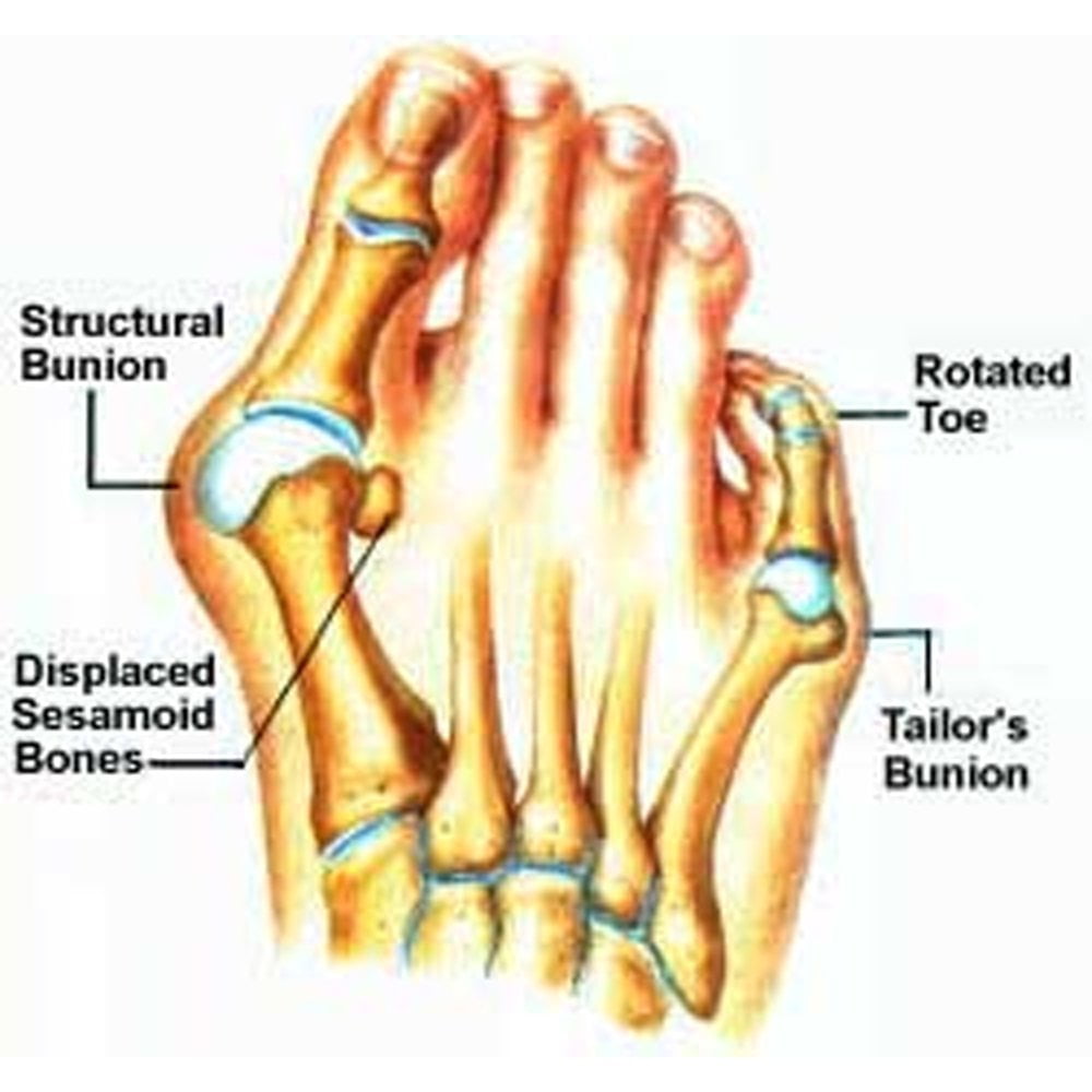 Bunion Corrector Sleeve with Gel Pad Toe Separator, Spacer, Straightener and Spreader for Complete Protection and Bunion Pain Relief 1 Pair