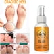 thumbnail image 2 of Spray Para Pies A Base De Hierbas Anti Hongos Alivia La Crema Beriberi Cuidado De La Piel Tratamiento Del Dedo Pie Infección Micótica Reparación De, 2 of 3