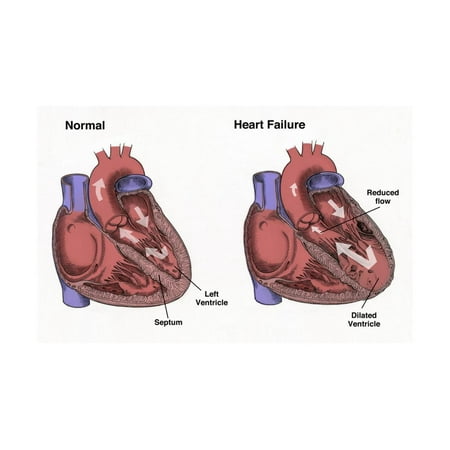 Healthy Heart vs. Heart Failure Print Wall Art By Spencer (Best Sleeping Position For Heart Failure)