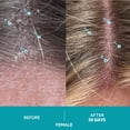 thumbnail image 4 of Champú DS Labs Dandrene Dandruff, 205 ml, exfoliante para cuero cabelludo, 4 of 9