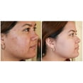 thumbnail image 4 of Lavado salicílico Ayur-Medic para pieles con imperfecciones, 4 of 4