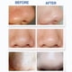 thumbnail image 5 of Aspiradora de poros para eliminar espinillas, herramientas para eliminar espinillas, aspiradora facial eléctrica, 5 of 5