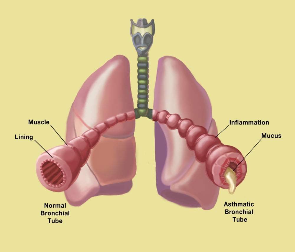 normal-vs-asthmatic-bronchial-tubes-poster-print-by-spencer