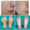 thumbnail image 2 of Crema Para Verrugas Eliminador de verrugas, crema para aliviar el dolor, verruga, topo, etiqueta de la piel, eliminar ungüento para el cuidado de la piel, 2 of 6