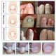 thumbnail image 4 of Clip de enderezamiento para uñas Jinwen Corrector de uñas encarnadas, 4 of 8