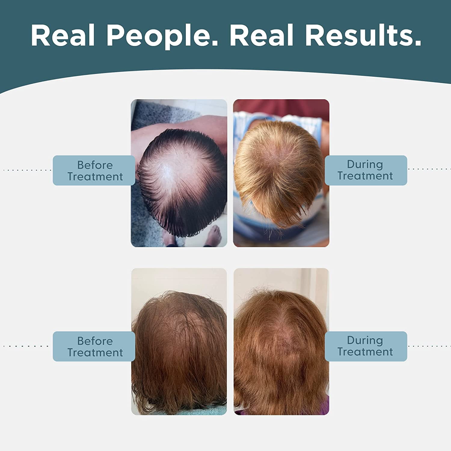 Buy Shapiro MD Minoxidil 5 Men's Hair Growth Treatment, FDA Approved