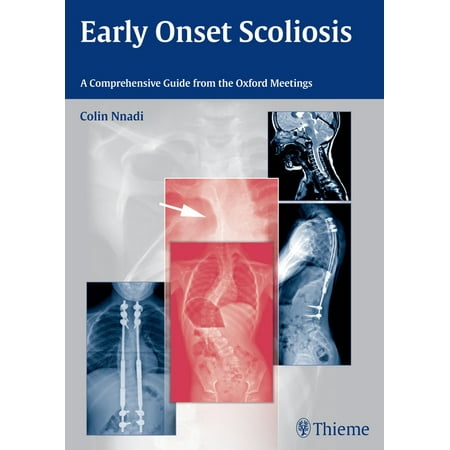 UPC: 9783131726612 | Early Onset Scoliosis: A Comprehensive Guide from the Oxford Meetings (Hardcover)