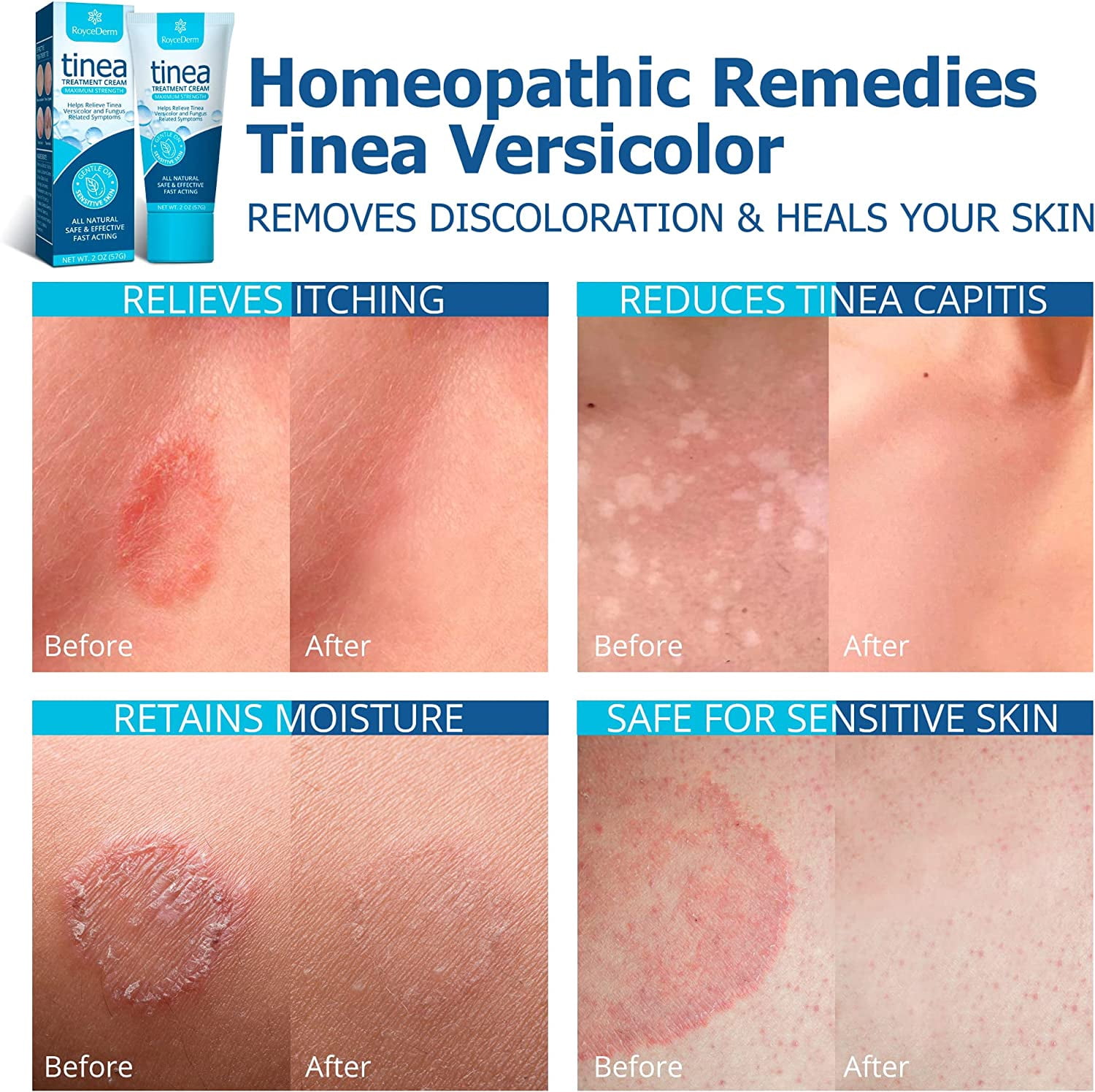 Roycederm Tinea Versicolor Treatment, Athletes Foot Treatment, Ringworm Treatment for Humans, for Tinea Versicolor & Pedis,Fast Healing Anti Fungal Skin Cream