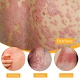 thumbnail image 3 of Crema Para El Cuidado De La Psoriasis, Crema Profesional Para Aliviar La Psoriasis 2 Piezas 0,7 Oz Para La Piel, 3 of 7