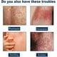 thumbnail image 2 of Pomada para el tratamiento del prurito, Yanshi psoriasis soothing spray 30ml reduce el enrojecimiento y la inflamación de la piel, tanto para hombres como para mujeres Yanshi Pomada para el tratamiento del prurito, 2 of 6