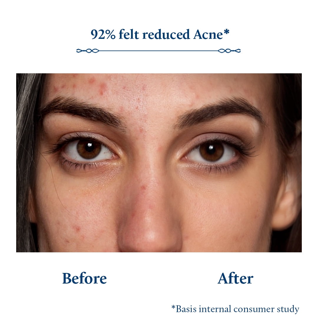 Blue Nectar Plum Face Serum for Acne Prone Skin | Oil Free Anti Acne Serum for Oily Skin (8 Herbs, 1 Fl Oz)