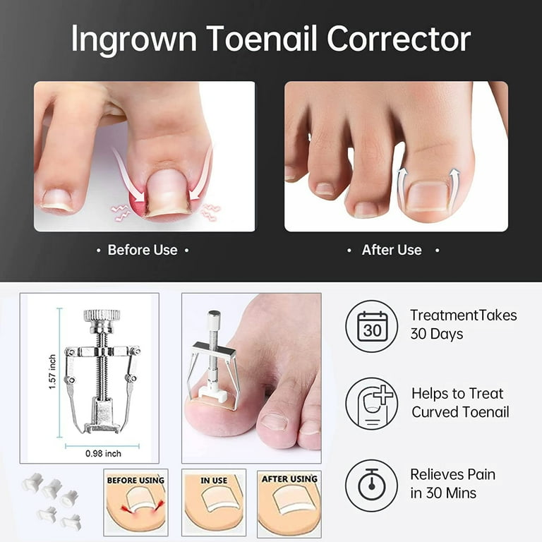 107PCS Ingrown Toenail Treatment Kit, Ingrown Toenail Tool Kit, Ingrown  Toenail Corrector Strips, Ingrown Toe Nail File Lifter Pedicure Tool Kits  for